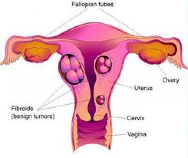 Uterine Fibroids - Importance of Kegel Exercise