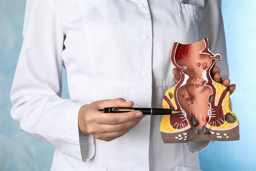 Can Kegel Exercises Help with Piles and Haemorrhoids?
