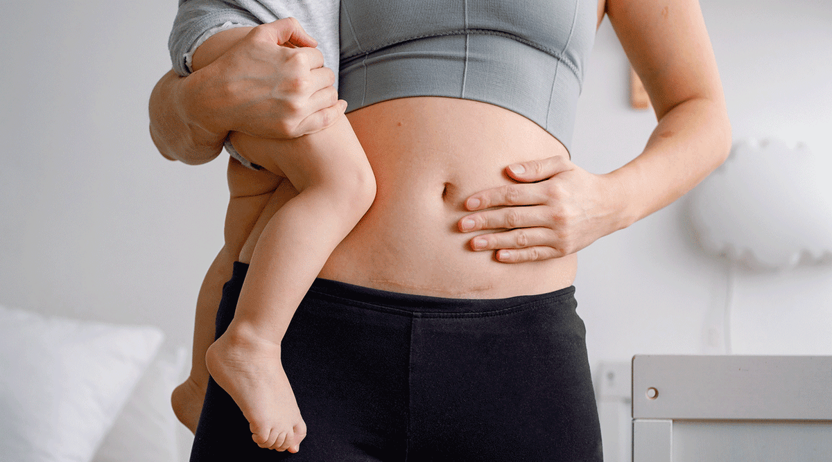 7 Tips for Accelerating Recovery After a C-Section