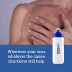 ScarGone Scar Management Massager 