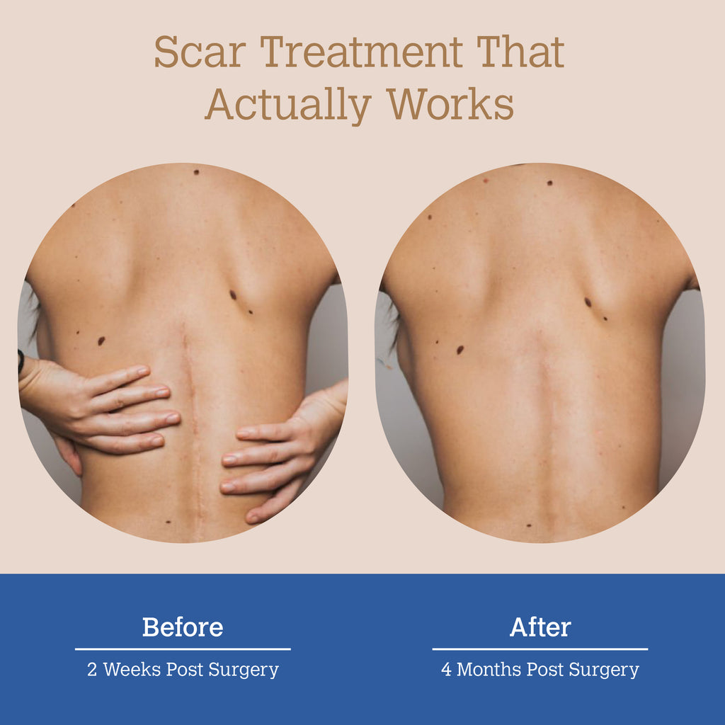 ScarGone Silicone Scar Gel