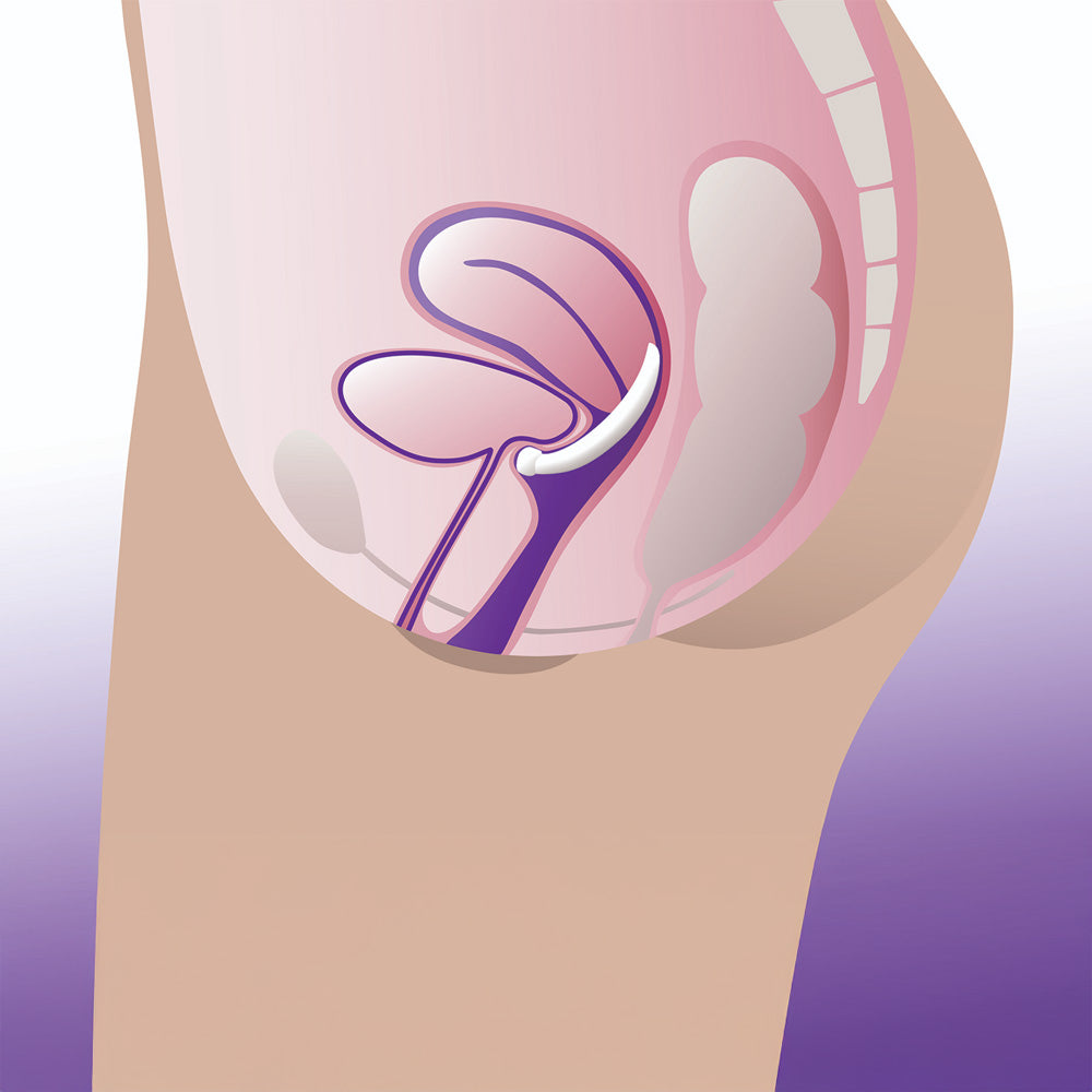 ProFem iDish Incontinence Pessary