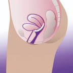 ProFem iDish Incontinence Pessary
