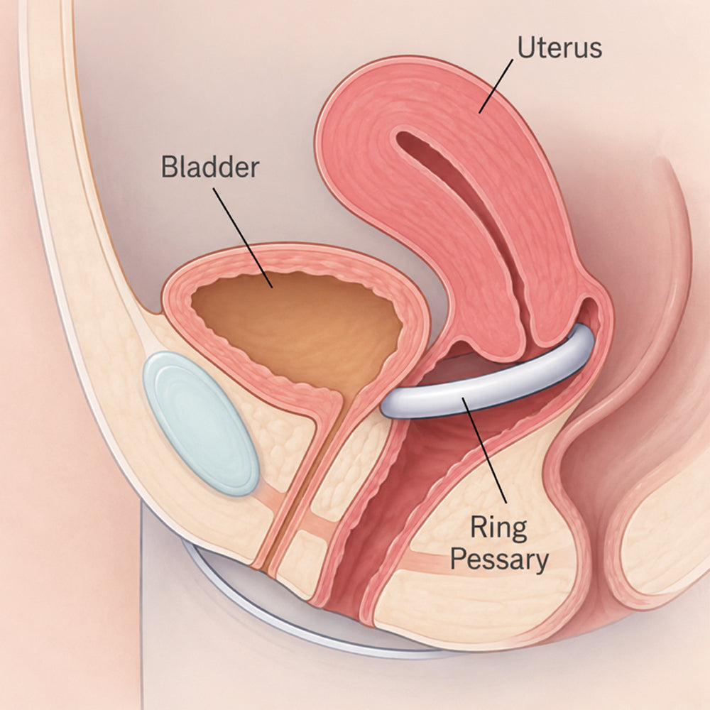 Balance Prolapse Ring Pessary With Support