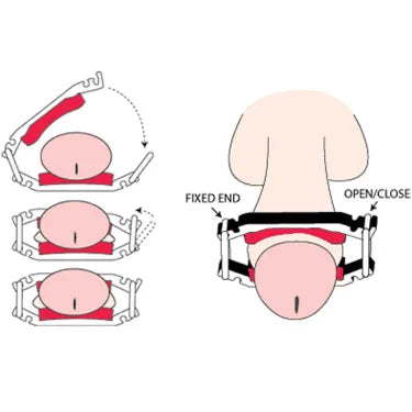 Dribblestop Male Urinary Penis Clamps