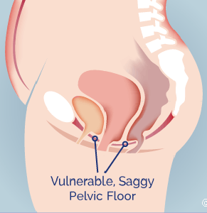 Picture of a weak pelvic floor that could prolapse because the pelvic organs are descending.