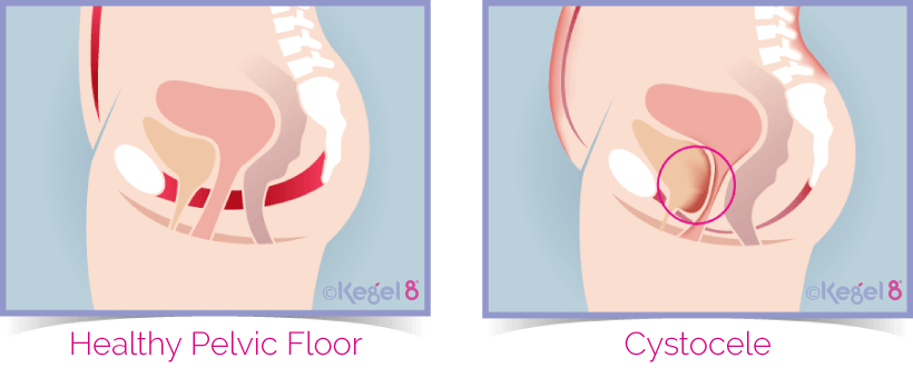 A Healthy Pelvic Floor vs Cystocele Prolapse