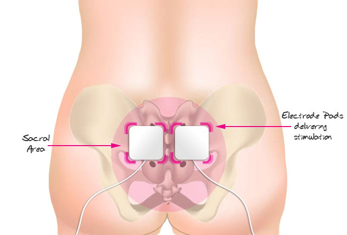 Erotic electrostimulation - Wikipedia