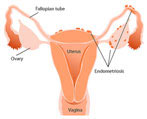 Endometriosis Diagram - Kegel8 Prevents Incontinence After Endometriosis Surgery