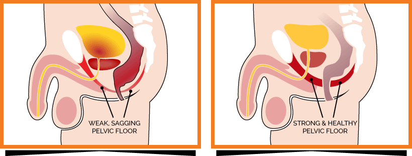 Diagram showing weak and strong male pelvic floor muscles