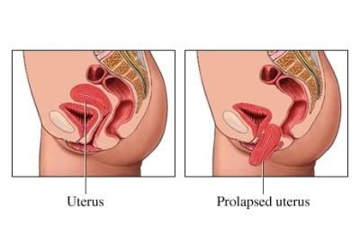Uterine Prolapse - Kegel8 Can Help