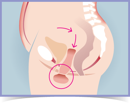 Womb / Uterine Prolapse - Phase 2 Prolapse Diagram