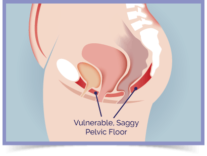 Diagram showing weak female pelvic floor muscles