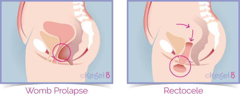Uterine Prolapse vs Rectocele Prolapse